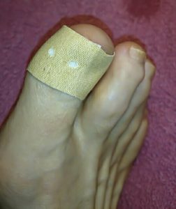 toe-05-plaster